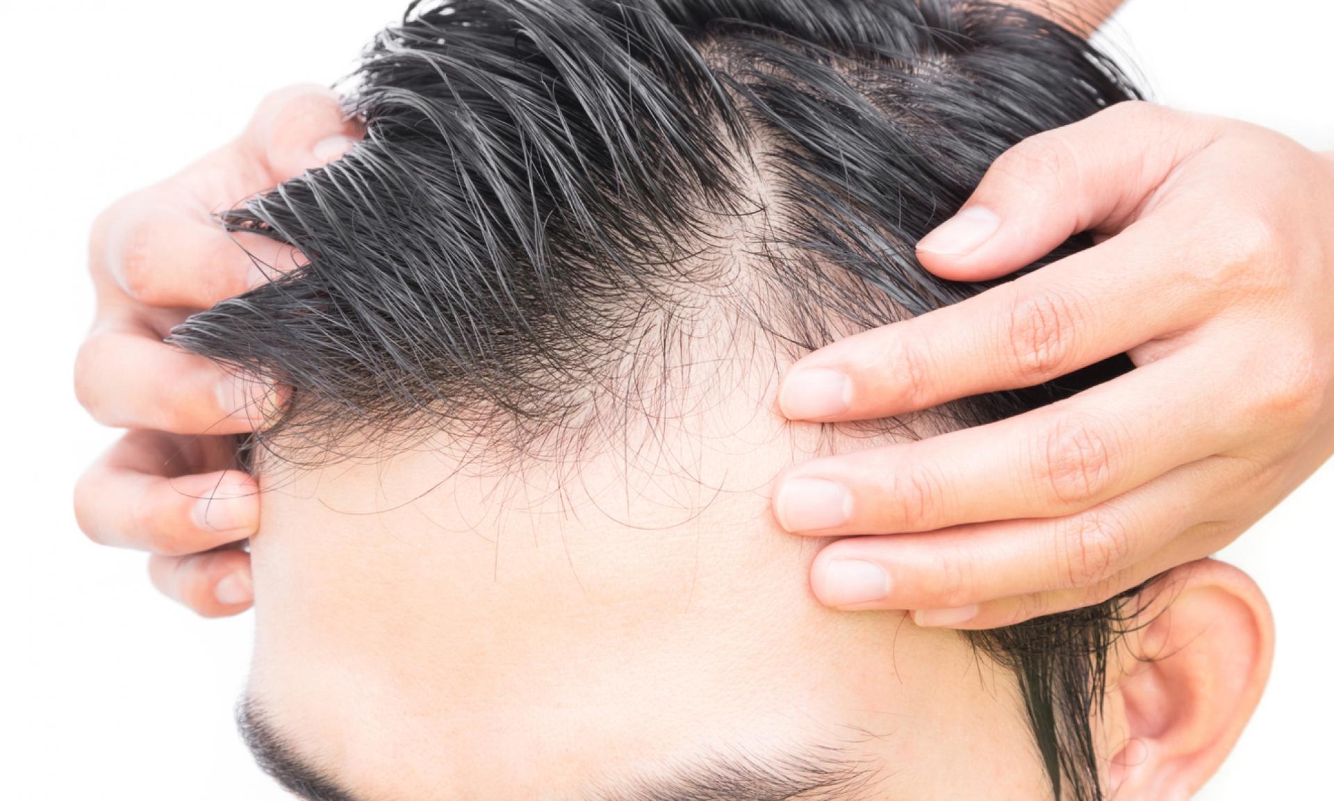 Is Hair Transplant The Most Effective Solution For Genetic Baldness